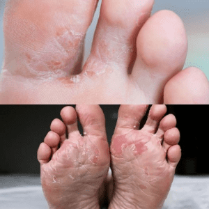 7 Easy Home Remedies to Treat Foot Fungus