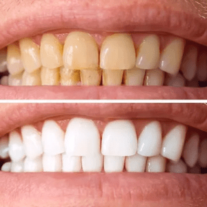 9 Natural Secrets for a Brighter Smile: Removing Plaque and Tartar