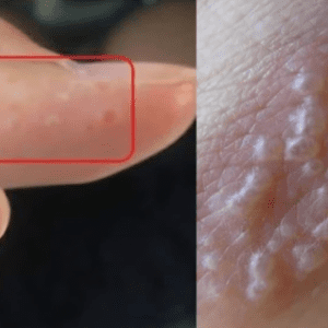 If You Notice Painful Red Bumps, You Might Have Dyshidrotic Eczema