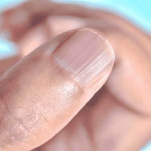 Understanding the Real Causes of Vertical Ridges on Your Nails